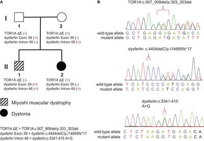Integrated Genome and Transcriptome Sequencing to Solve a Neuromuscular Puzzle: Miyoshi Muscular Dystrophy and Early Onset Primary Dystonia in Siblings of the Same Family